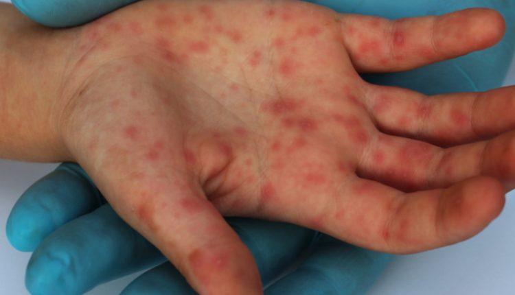Segundo caso de sarampo de MS é confirmado em bebê de Campo Grande