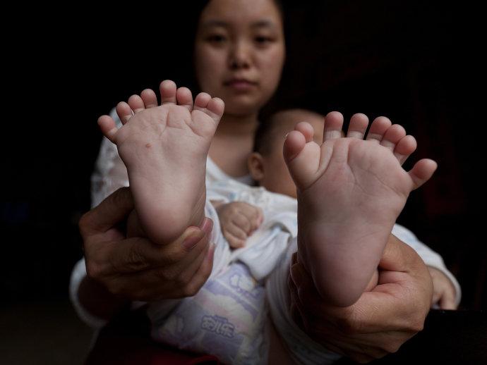Bebê chinês nasce com 31 dedos