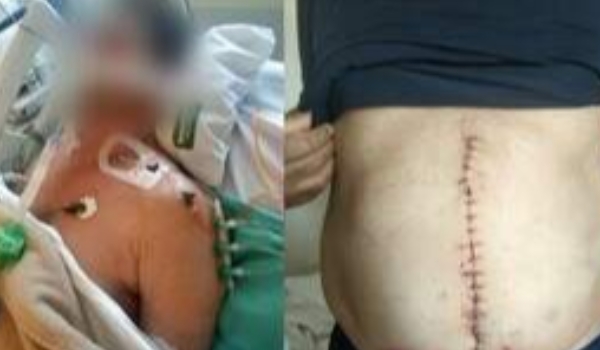 Espancado durante briga de cães, idoso perde o baço e passa 9 dias na UTI