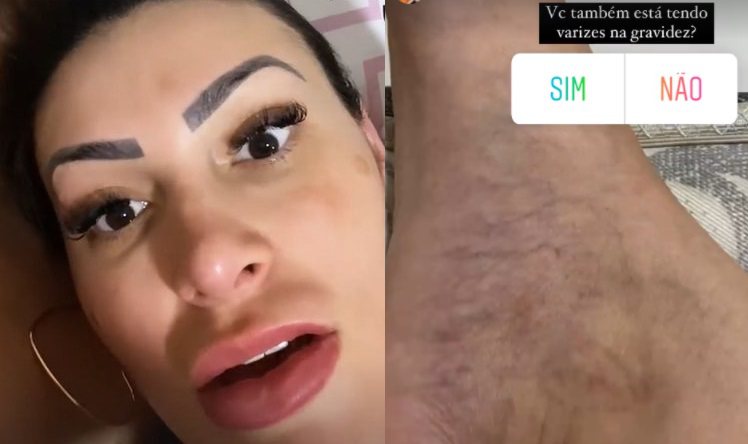 Andressa Urach se desespera com a aparição de varizes: 'estou ficando apavorada'