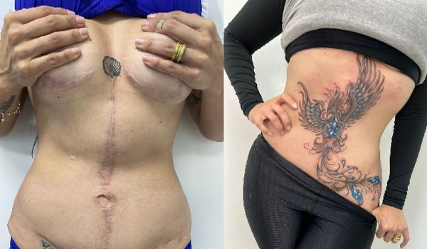 Tatuagens ressignificam cicatrizes de vítimas de violência doméstica e de cirurgias mal feitas