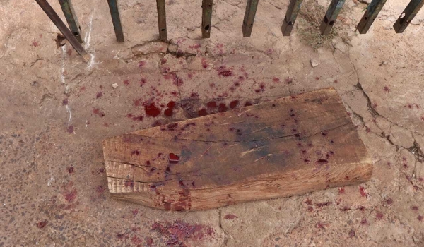 Homem que teve mão dilacerada por pitbull recebe alta da Santa Casa