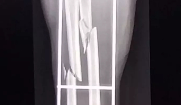 Por suspeita de furto, homem invade casa e quebra braço de indígena