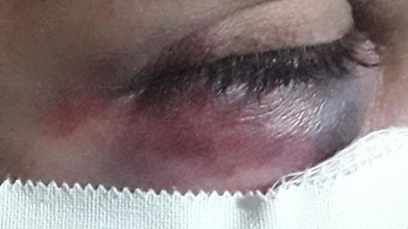 Mulher é socorrida com maxilar quebrado após ser espancada por marido que é preso pela PM