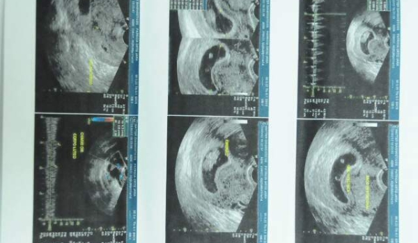 Mais de 500 adolescentes abortaram em MS desde 2008, mas apenas 2% foram legais