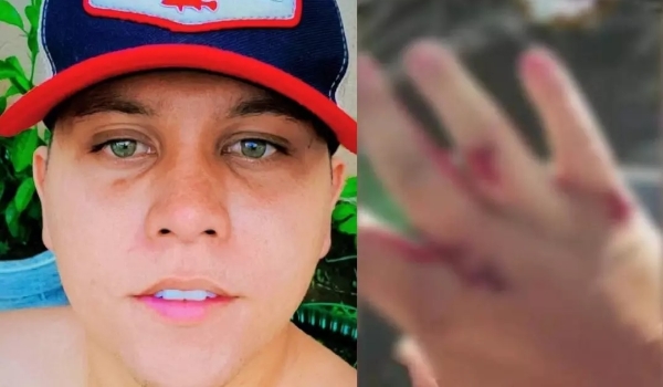 Homem abocanhado por sucuri em MS detalha momento do ataque: 'foi direto no osso'