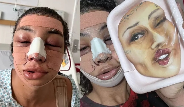 Feminilização facial: Linn da Quebrada passa por cirurgia para deixar o rosto mais feminino