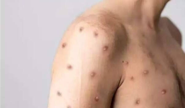 MS confirma 7 casos da Monkeypox de uma só vez e coloca 2 crianças em observação