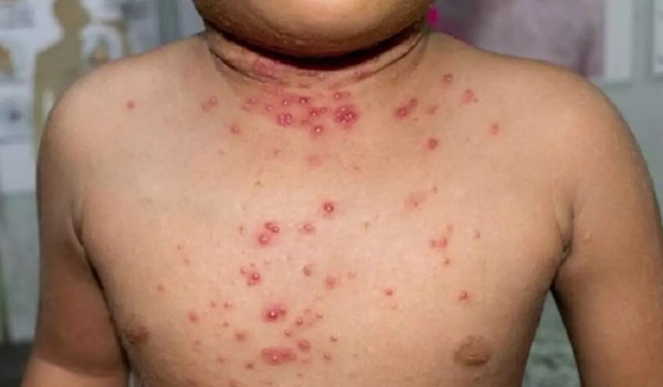 Sesau rastreou pessoas que tiveram contato com aluno de Emei que contraiu varíola dos macacos