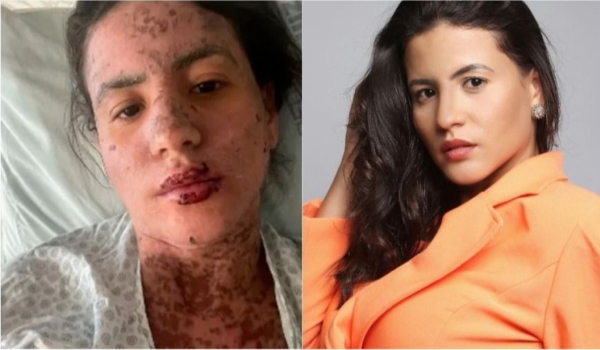 Síndrome de Stevens-Johnson: conheça a doença que afetou mulher de Frank Aguiar