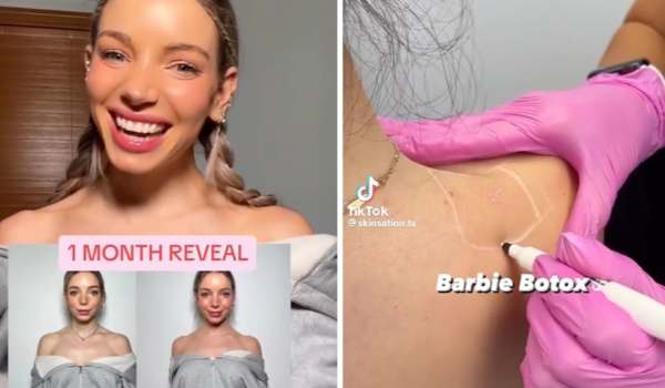 O que é o “Botox da Barbie”, a mais recente obsessão de beleza do TikTok