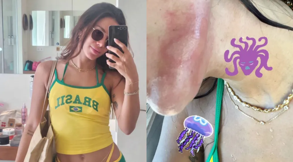 Anitta mostra marca de queimadura de água-viva em Ibiza, na Espanha | Instagram/Anitta