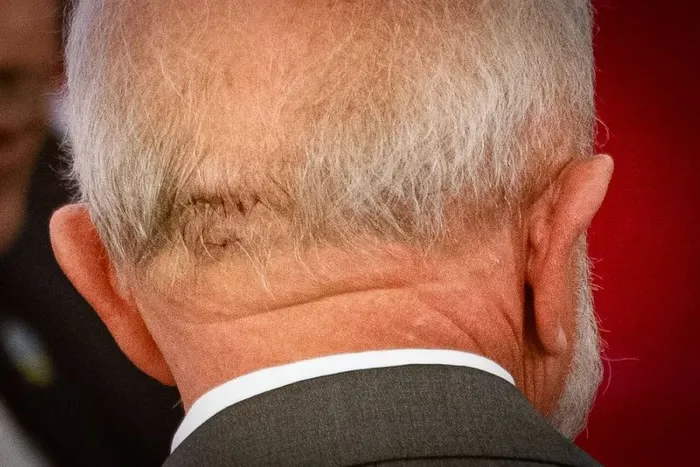 Presidente Lula tem hemorrragia cerebral e faz cirurgia de emergência