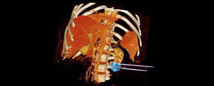 Técnica congela e retira tumor sem cortes