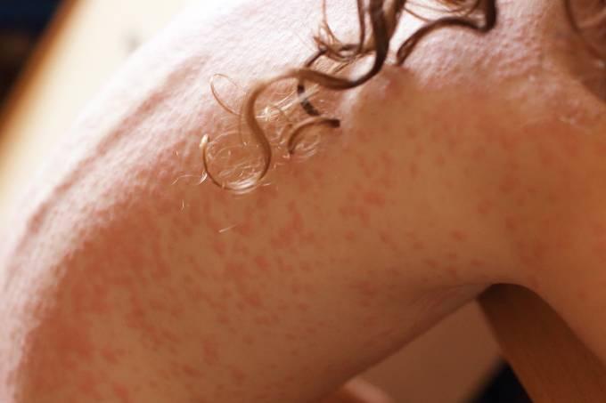 Nova droga contra dermatite já está disponível no Brasil